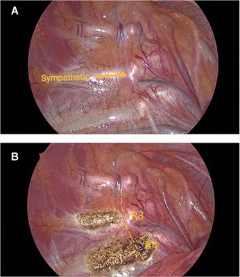 Impact of endoscopic thoracic R4 sympathicotomy combined with R3 ramicotomy for primary palmar hyperhidrosis